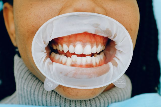 Myths and Facts About Dental Treatment: Everything You Need to Know