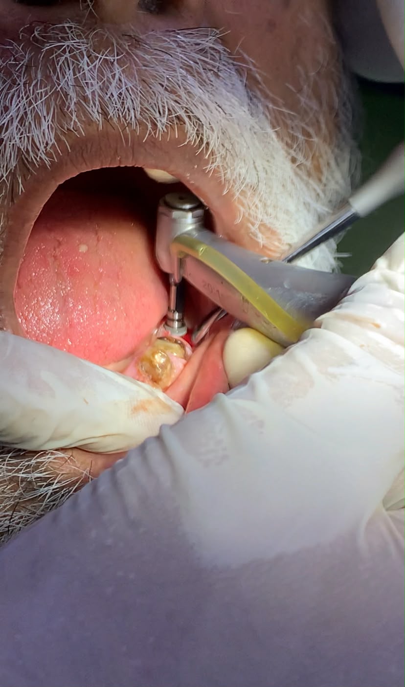 Dental Implants vs Bridges: Which Is Better?