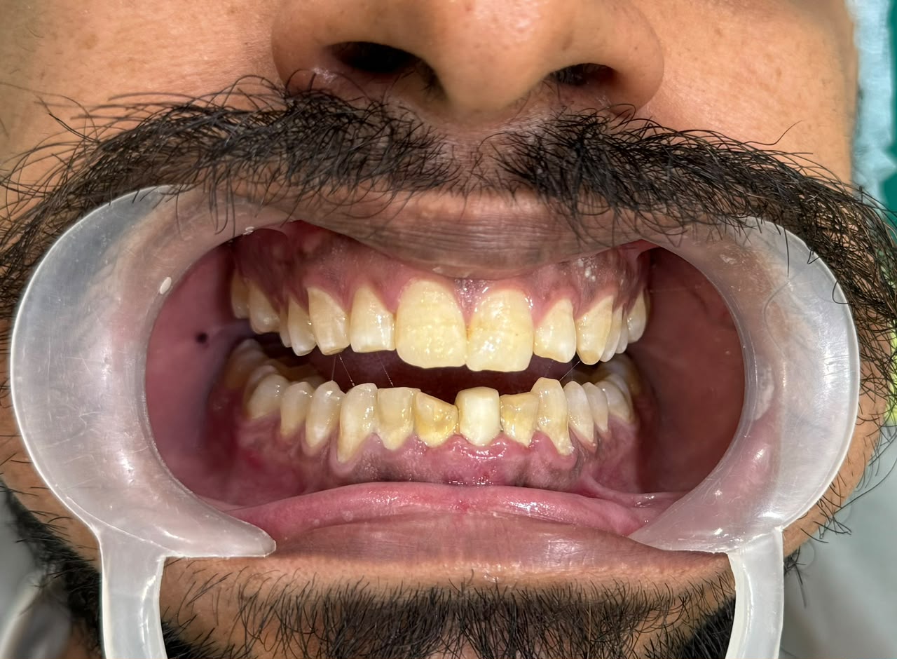 Tooth Infection, Tooth Infection Treatment, Tooth Infection Symptoms, Dental Infection, Tooth Abscess, Dental Abscess, Infected Tooth, Root Canal Treatment, Dentist in Delhi, Best Dentist in Delhi