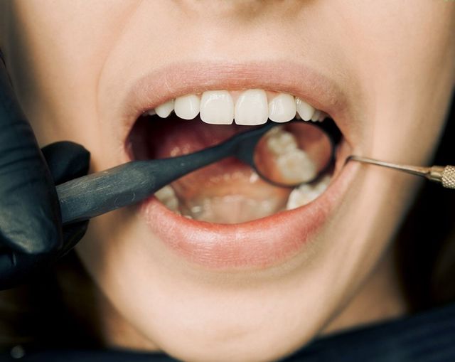 Bleeding Gums: Causes, Prevention & Treatment – A Complete Guide to Healthy Gums