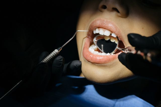 Dental Cavities: Causes, Warning Signs, Prevention & Treatment – Everything You Need to Know