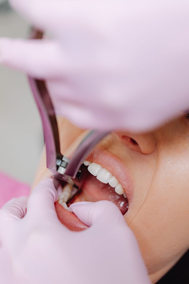 Dental tooth extraction treatment Dentist examining a tooth before extraction Tooth extraction recovery and aftercare Wisdom tooth extraction procedure