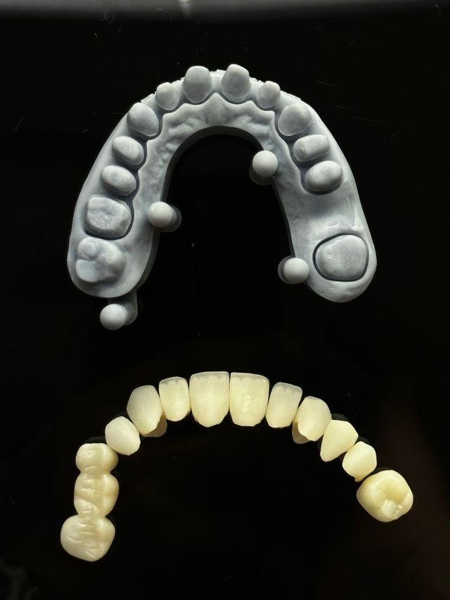 Dental Crowns, Dental Crown Treatment, Dental Crown Procedure, Types of Dental Crowns, Dental Crown Cost, Dental Crown Aftercare, Tooth Crown, Porcelain Crowns, Ceramic Crowns, Zirconia Crowns, Dental Crowns in Delhi, Dentist in Delhi, Best Dentist in Delhi