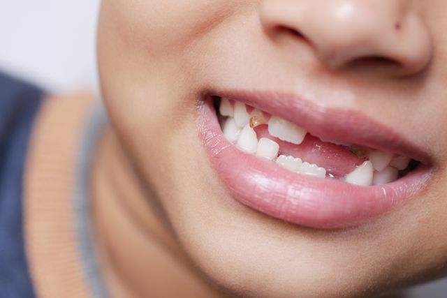 Missing teeth and tooth replacement treatment options